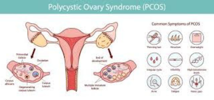 PCOS क्या है? लक्षण, कारण, डाइट और 2026 के नए इलाज (Complete Guide)